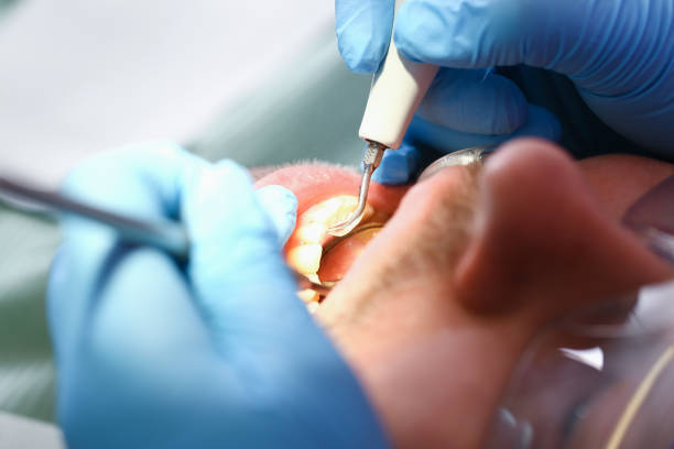 Best Emergency Dental Extractions in Hodgkins, IL
